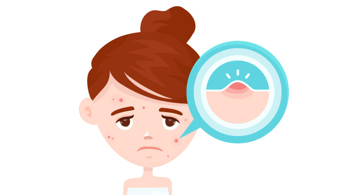 What Are The Different Types of Acne and How To Treat Them – SkinKraft