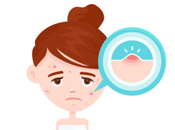 Acne: Causes, Symptoms, Treatments & Prevention Tips