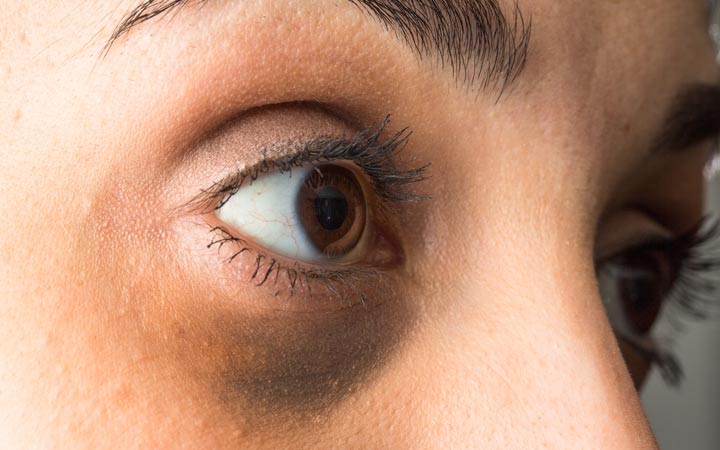 do cigarettes cause dark circles How to Remove Under Eyes Permanently AreoVeda Post-Smoking Skin Woes: Why Dark