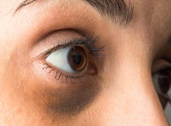 Dark Circles Under Your Eyes: Causes, Treatments & Prevention Tips