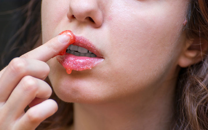 oral melanotic macule treatment at home Lip Pigmentation Singapore DermDx: Brown Macule on Lip