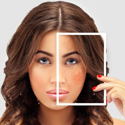 How To Get Rid Of Hyperpigmentation Acne
