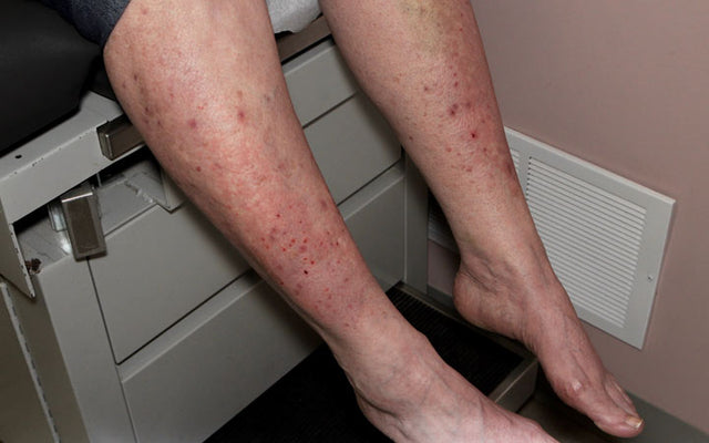 Dermatitis Herpetiformis and Gluten Intolerance: What Is The Connection?