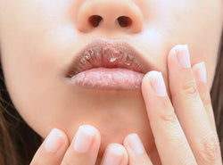 How To Soothe Chapped & Dry Lips: 5 Causes, 5 Remedies & FAQs