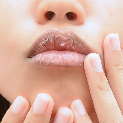 How To Soothe Chapped & Dry Lips: 5 Causes, 5 Remedies & FAQs