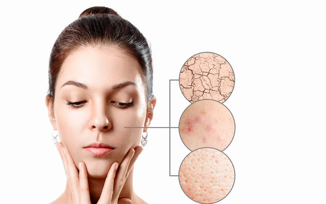 Dry Skin And Acne: Are You Treating It The Right Way?
