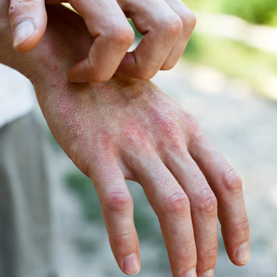 Psoriasis Vs. Eczema - How To Diagnose Your Skin Condition Correctly?