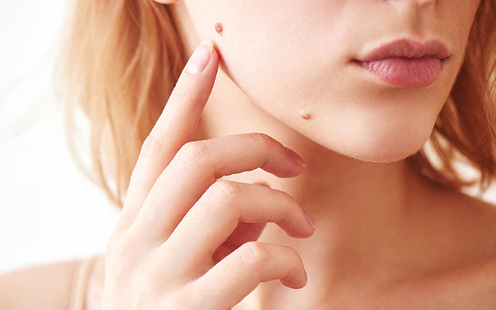 How do we remove moles?! If you have a mole on your face, seeing a