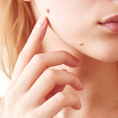 How To Get Rid Of Moles From Your Skin?