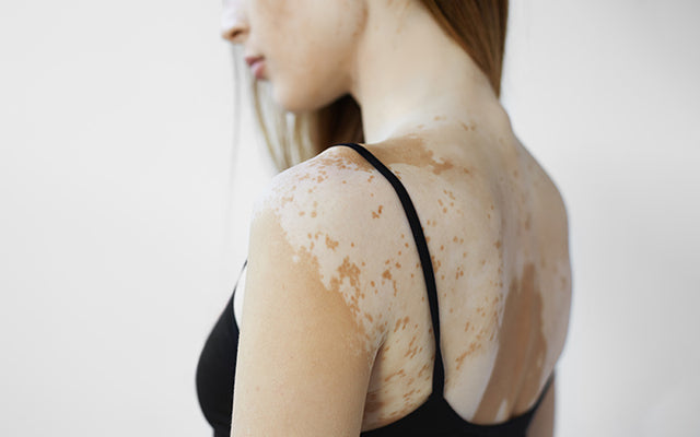 How To Treat Discolored Skin Patches?