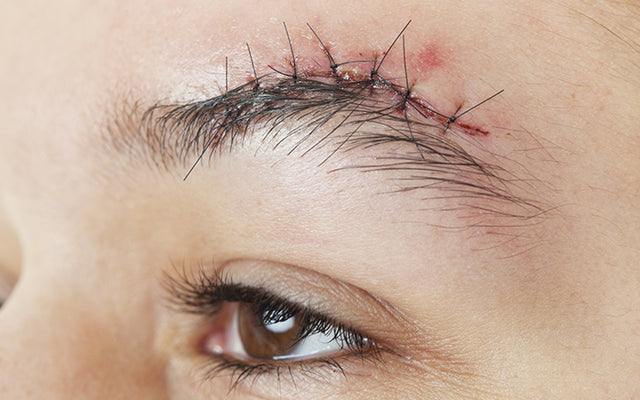 10 Ways To Remove Stitch Marks On Your Face!