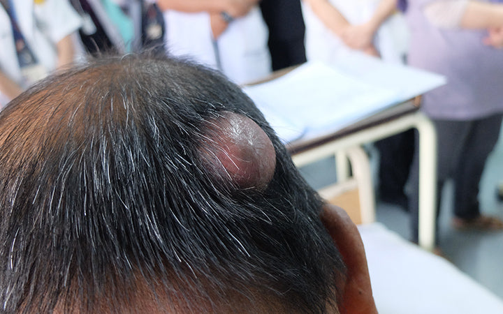 How Can You Control Pilar Cysts On Your Scalp SkinKraft how-can-you-control-pilar-cysts-on-your-scalp-skinkraft