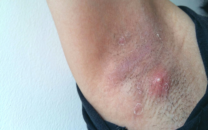 bacterial infection armpit lump