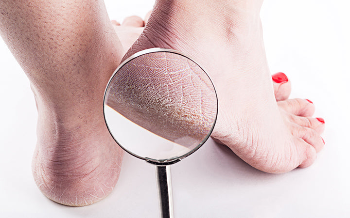 DIY home remedies for smooth heels and beautiful feet