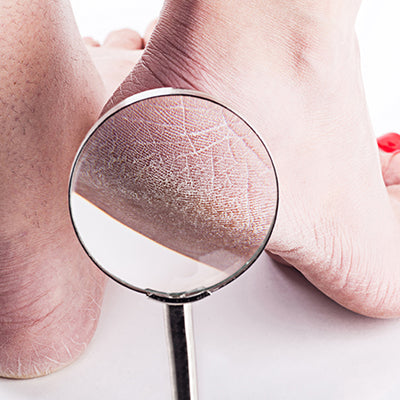 5 Easy Ways To Treat Cracked Heels
