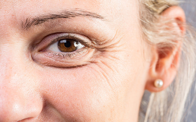 Crow’s Feet Around The Eyes: Causes, Treatment And Prevention