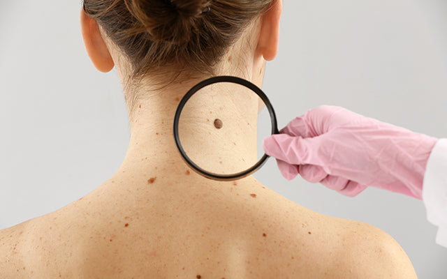 Skin Cancer: Types, Symptoms, Causes & Treatments