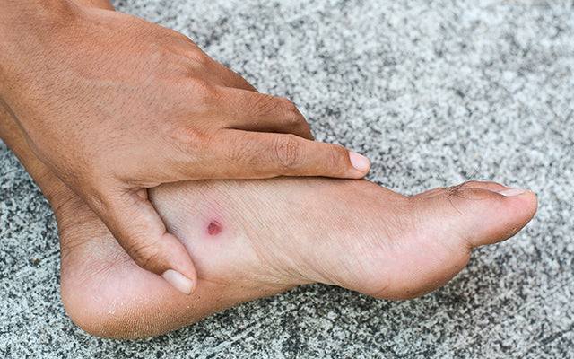 All About Skin Ulcers & How You Can Prevent Them