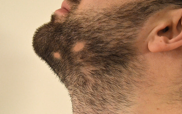 Is Alopecia Barbae Causing Bald Patches On Your Beard?