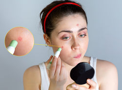 8 Great Ways To Hide Your Pimples!
