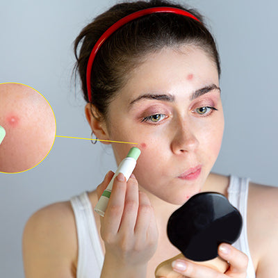 8 Great Ways To Hide Your Pimples!