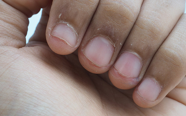12 Reasons Why Your Fingertips May Be Peeling