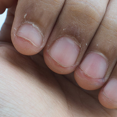 12 Reasons Why Your Fingertips May Be Peeling