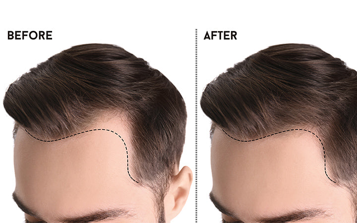 normal hairline vs receding