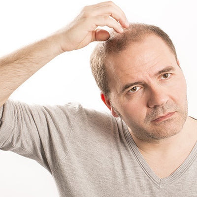 8 Reasons Behind Premature Baldness & How To Treat It