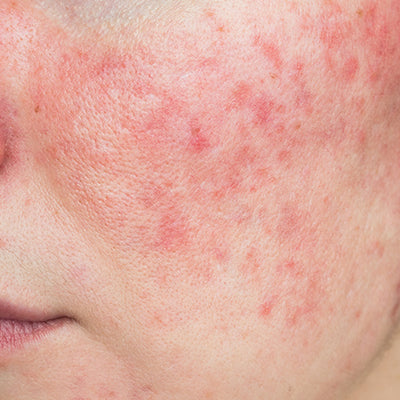 Acne Vulgaris Vs Acne Rosacea: Understanding The Difference