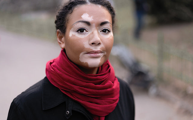 Vitiligo: Types, Symptoms, Diagnosis & Treatments