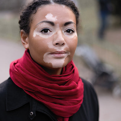 Vitiligo: Types, Symptoms, Diagnosis & Treatments