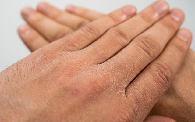 What Is Exfoliative Dermatitis & How Does It Look? + Causes And Ways To Treat