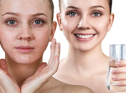 The Best Anti-Acne Drinks To Achieve Glowing Skin