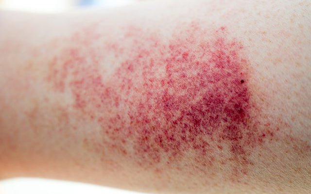 Understanding Fungal Acne + Causes, Treatments, Dos & Don'ts