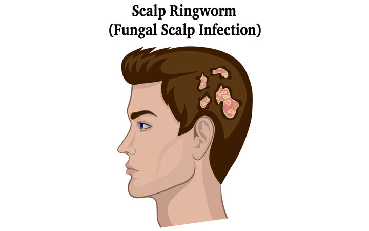 Suffering From Scalp Ringworm (Tinea Capitis): Know Its Treatment