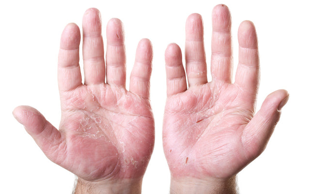 Hand Dermatitis: Causes, Prevention & Treatments