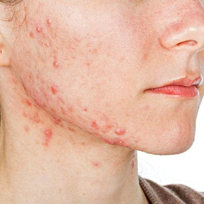 How To Identify And Treat Nodular Acne?