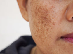 How Do I Get Rid Of Melasma (Dark Patches) On My Face
