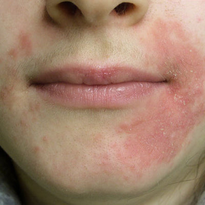 Perioral Dermatitis: Cure, Signs, Risks & Everything You Need To Know