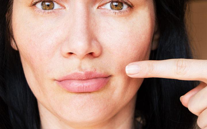 does too much vitamin c make your upper lip swell What could be causing my child's swollen and cheek? Upper lip swelling in granulomatous