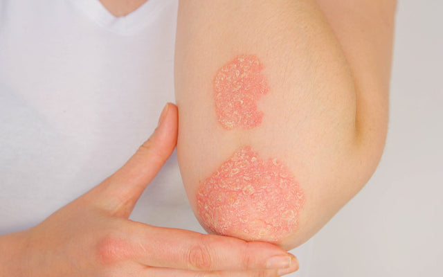 Is Psoriasis A Serious Skin Condition? Can It Be Treated?