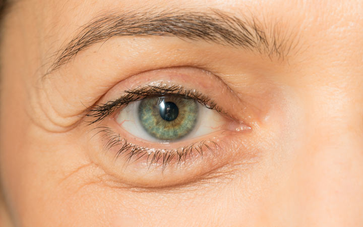 What Causes Puffy Eyes?