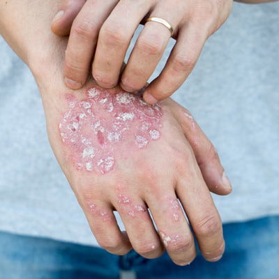 Permanent & Temporary Skin Disorders: How To Manage