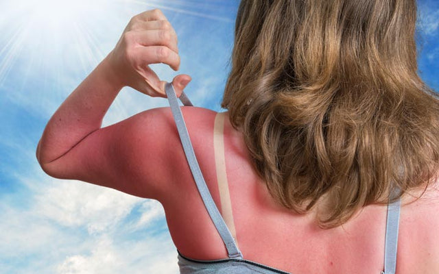 Sunburn On Face - Causes, Symptoms And Treatments