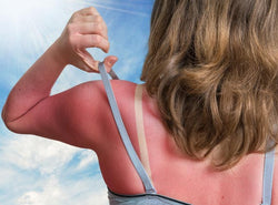 Sunburn On Face - Causes, Symptoms And Treatments