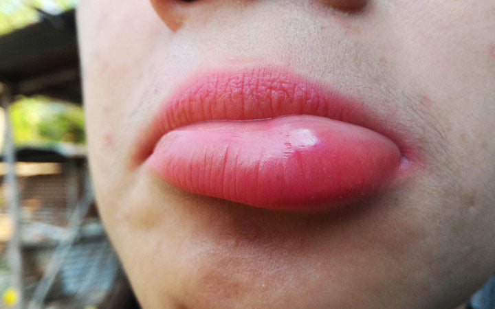 vitamin c for lip swelling allergy Allergic reaction on lips: Causes, symptoms, treatment, and more Home remedies for swollen lips