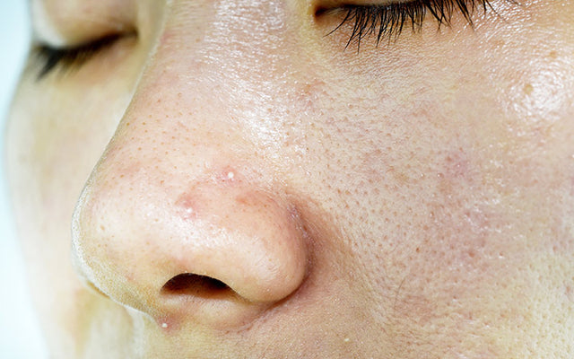 Oily Skin - Causes, Prevention, Treatments