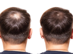 The Best DHT Blockers & How They Can Combat Hair Loss
