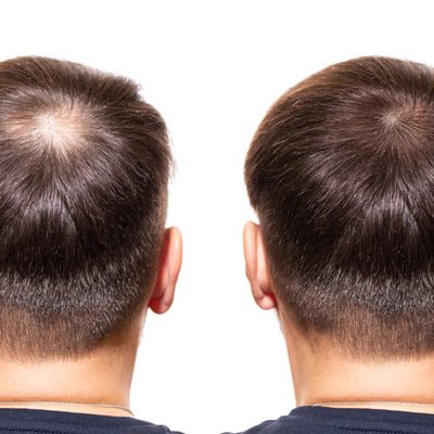 The Best DHT Blockers & How They Can Combat Hair Loss